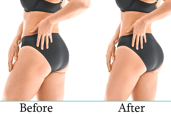 Body Contouring Results