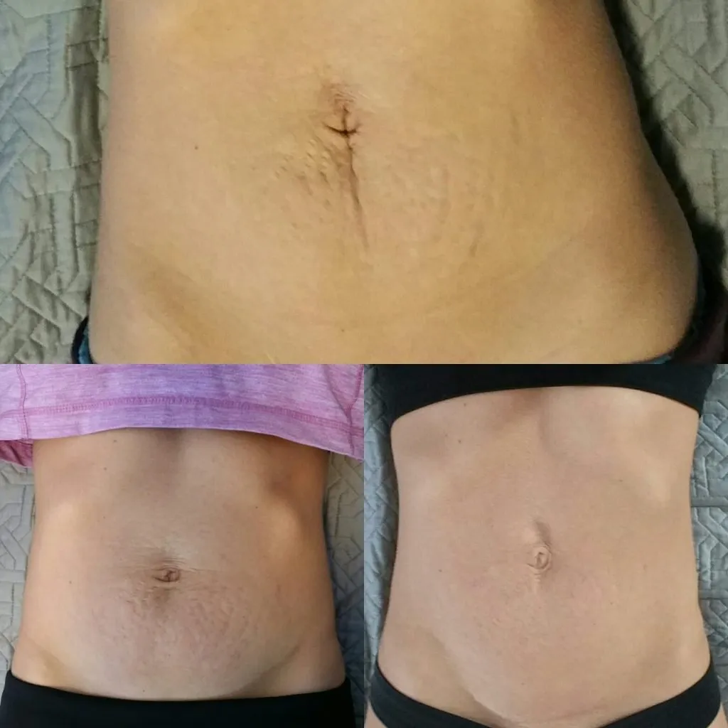 Body Contouring